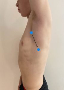 A person's left lateral chest naked, with blue dots outlining the patter of auscultation.