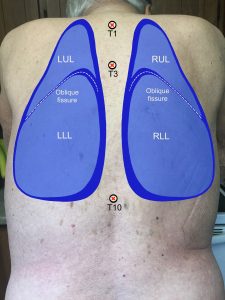 Posterior image of a naked person's back. The back has drawings of the left upper and lower lobes, as well as the right upper, middle, and lower lobes including the oblique fissures.