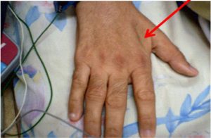 The interosseous muscle is depressed in a patient with muscle wasting