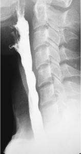 Fluoroscopic image of a barium swallow, cropped to show the esophagus from a side profile. The liquid bolus appears a bright white as it flows uninterrupted down the esophagus.