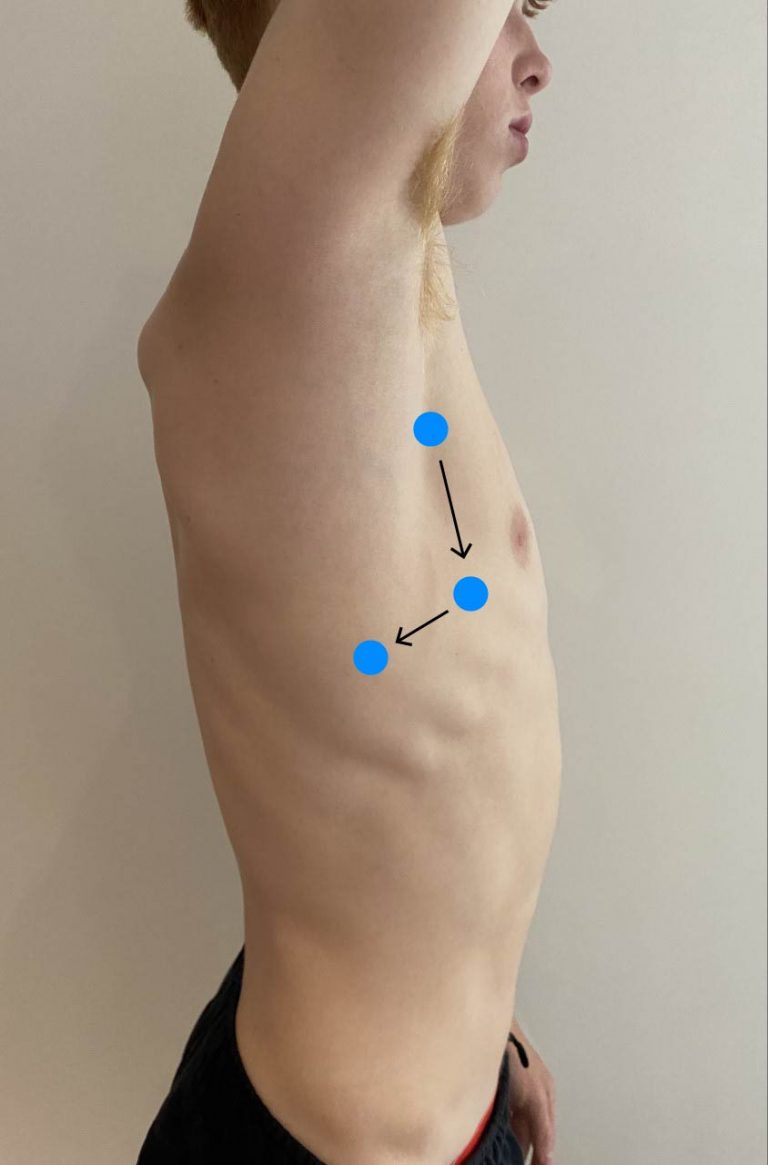 Posterior And Lateral Thorax Percussion Introduction To Health Assessment For The Nursing