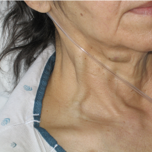 A distended jugular vein.