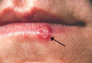 A person with herpes (cold sore) on the left side of their lower lip.