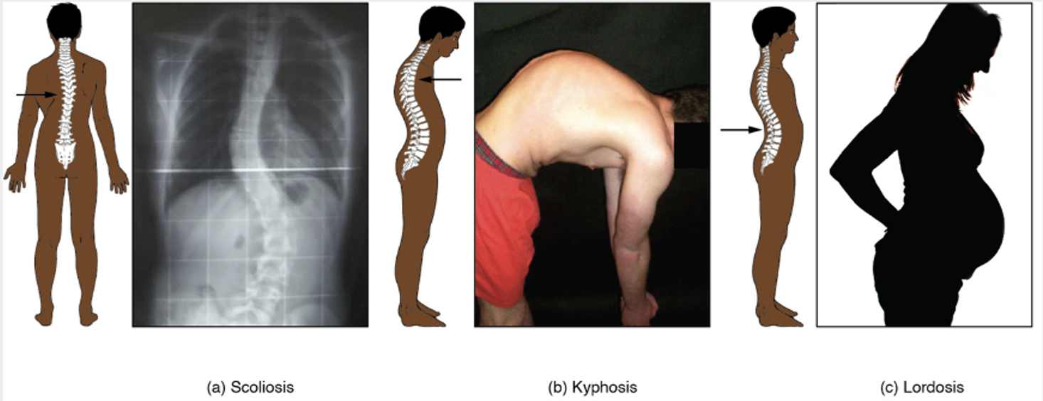 Curvatures of the spine in cases of scoliosis, kyphosis and lordosis.