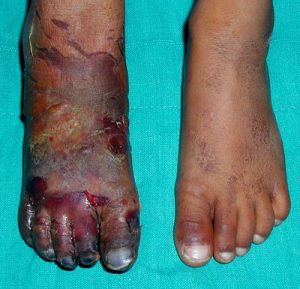 Gangrenous tissue on one foot.