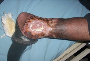 Venous insufficiency and venous ulcer.