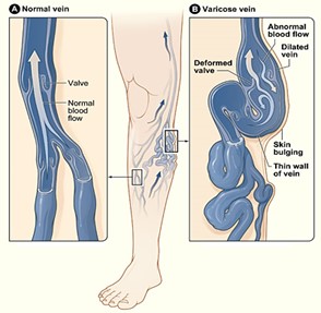 Normal veins and then bulging twisted varicose veins.