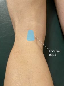Blue box on the back of the knee in the popliteal fossa just lateral to the medial tendon