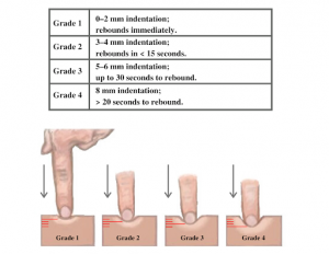 A table showing what grade 1-4 pitting edema is with a visual representation of the size of the indent.