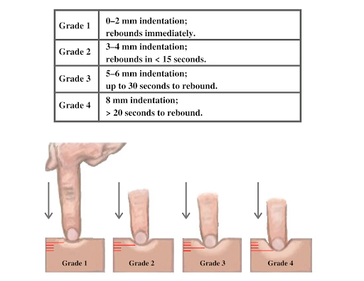 Eine Tabelle, die zeigt, was ein Ödem der Grade 1–4 ist, mit einer Abbildung, die die Größe der Vertiefung zeigt.