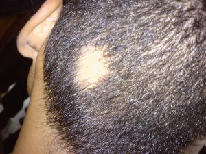 A patch of missing hair on the back of the head.