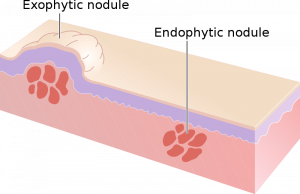 An animated image of an exophutic nodule and endophytic nodule on the skin.