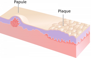 An animated image of a papule and plaque on the skin.