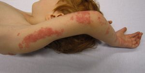 Coalesced patches of red lesions on the arm from the wrist to the upper arm.