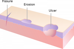 An animated image of a fissure, erosion, and ulcer (left to right) on the skin.
