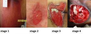 Four pictures showing stage 1, stage 2, stage 3 and stage 4 of pressure injuries.