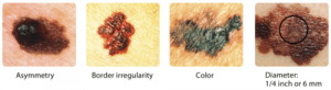 Four pictures showing an asymmetrical nevi, a mole with border irregularity, a mole with colour variation, a large mole.
