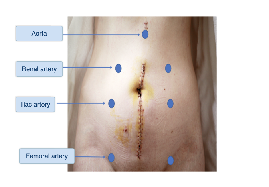 Abdomen – Inspection – Introduction to Health Assessment for the