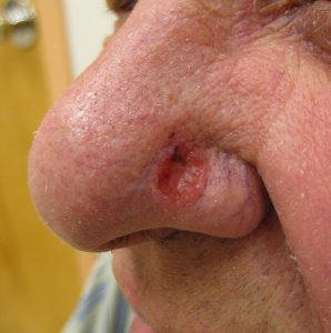 A reddened lesion on the nose with a dark area on the superior edge of the lesion.