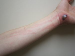 Signs of cellulitis on hand.