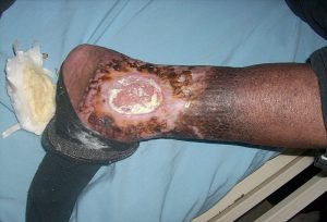 A large open sore on the posterior side of the ankle/leg with white and brown discolouration.