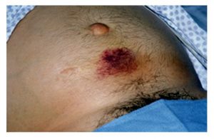 A dark brown and red bruise on a swollen abdomen below the umbilicus.