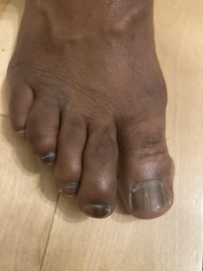 A person's right foot. The big toe is discoloured at the base with a line down the middle which is nail fungus.