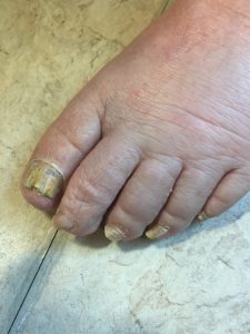 A person's left foot. The big toe is yellowish in colour and has nail fungus.