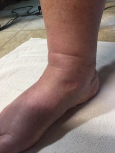 Indent showing pitting edema on medial/dorsal side of foot.