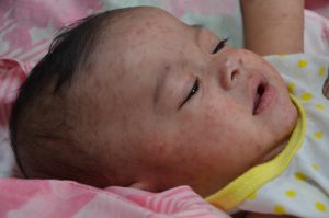 Flat red dots on a child's face.