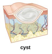 An animated image of a cyst on the skin.