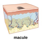 An animated image of a macule on the skin.