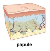 An animated image of a papule on the skin.