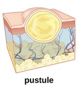 An animated image of a pustule on the skin.