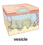 An animated image of a vesicle on the skin.