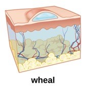 An animated image of a wheal on the skin.