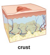 An animated image of crust on the skin.