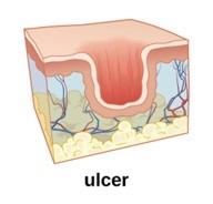 An animated image of an ulcer on the skin.