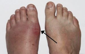 Two feet with a black arrow pointing at a reddened area on the left foot.