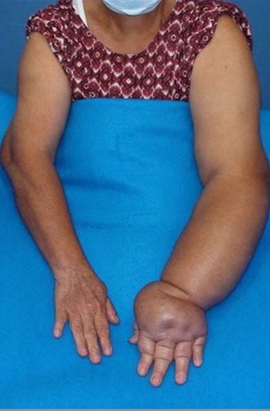 A severely swollen left arm in comparison to the right arm.