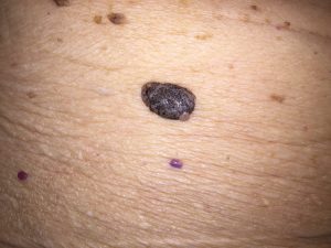 A dark brown raised lesion that is waxy with slight bumps throughout.