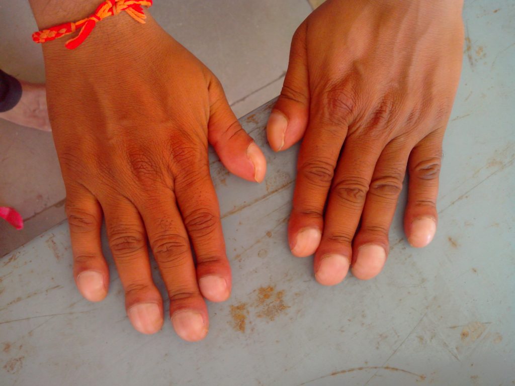 Two hands showing bulbed-like fingertips.