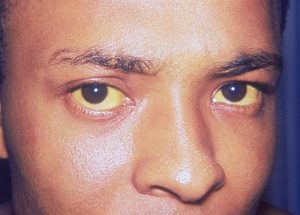 A person's face that has jaundice eyes and skin.