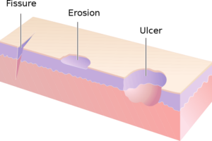 An animated image of a fissure, erosion, and ulcer (left to right) on the skin.