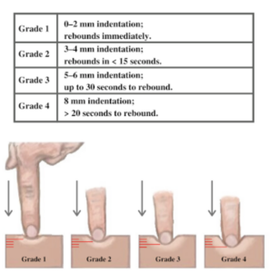 A table showing what grade 1-4 pitting edema is with a visual representation of the size of the indent.