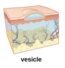 Vesication Skin: Inspection – Introduction to Health Assessment for the Nursing ...