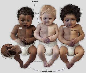 Three babies showing cyanosis in different shades based on skin colour.