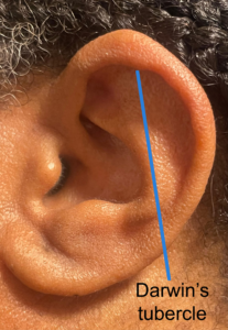 Shows a small nodule on the ear's helix